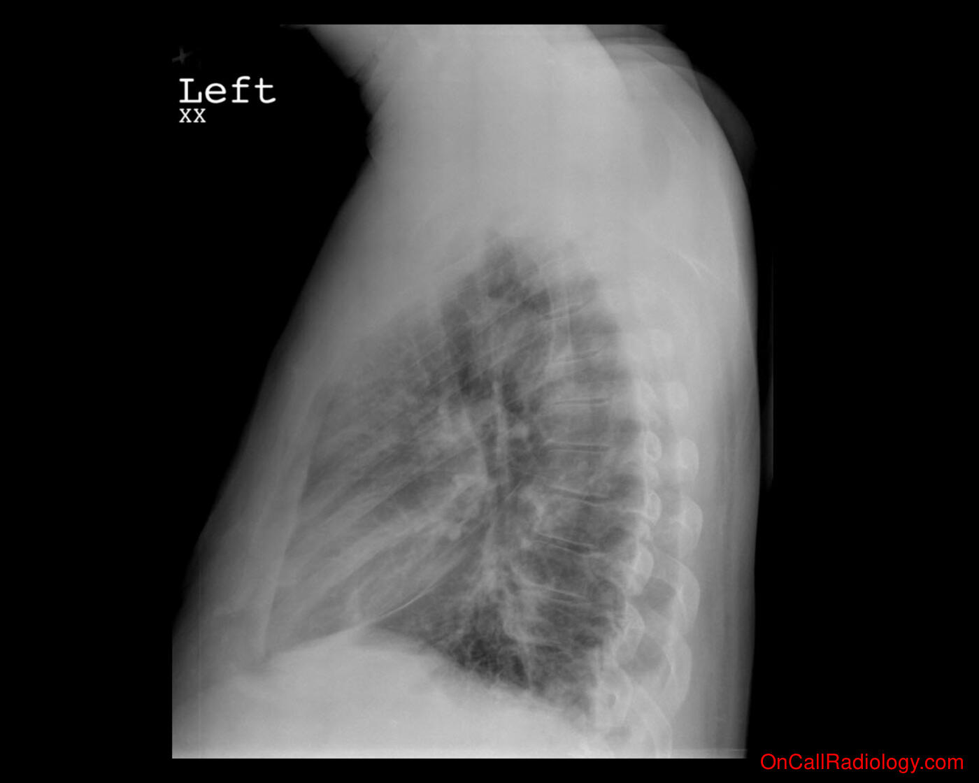 CHF (Mild CHF - Plain film, Radiograph)