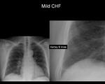 Mild CHF