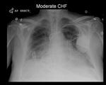 Moderate CHF