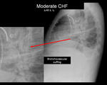 Moderate CHF