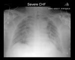 Severe CHF