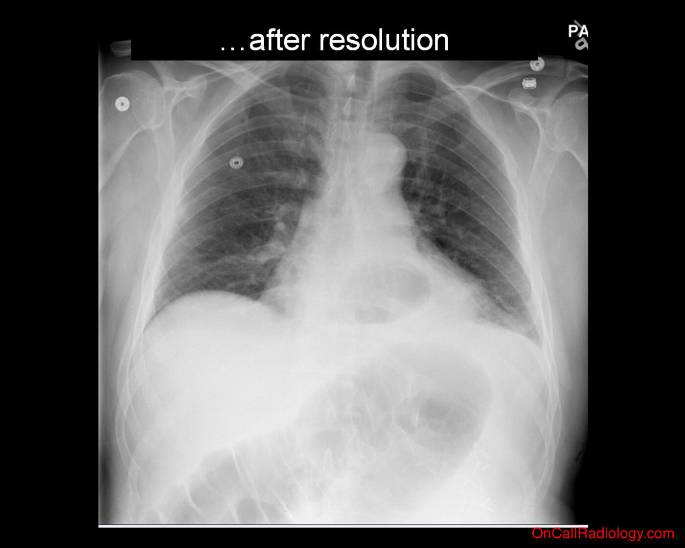 CHF (Severe CHF - Plain film, Radiograph)