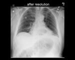 Severe CHF