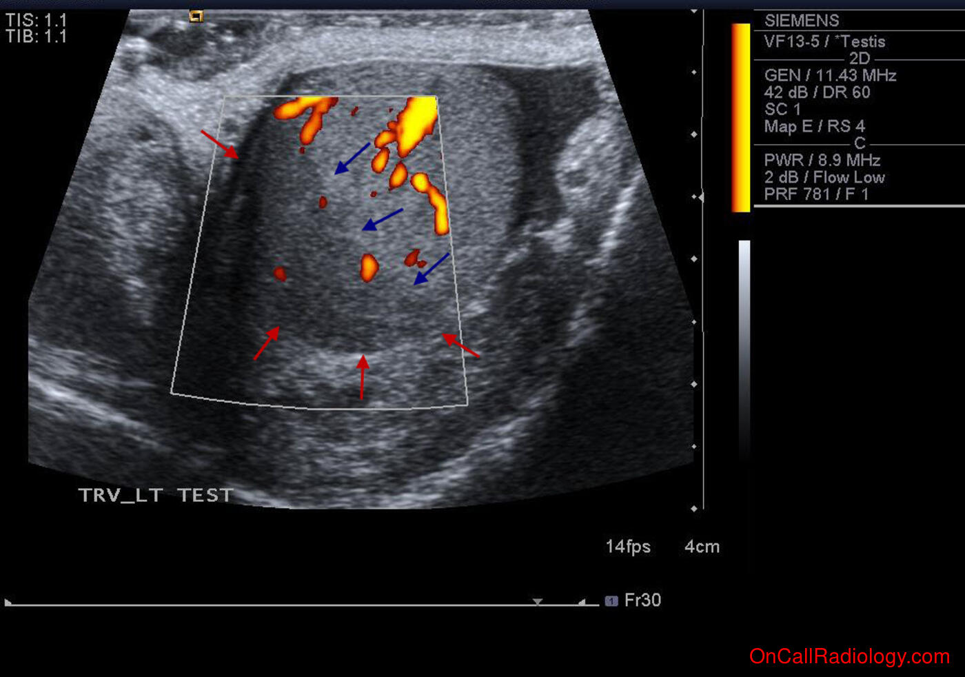 Male (Parrtial testicular infarct - Ultrasound)
