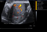 Parrtial testicular infarct