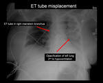 ET tube misplacement 