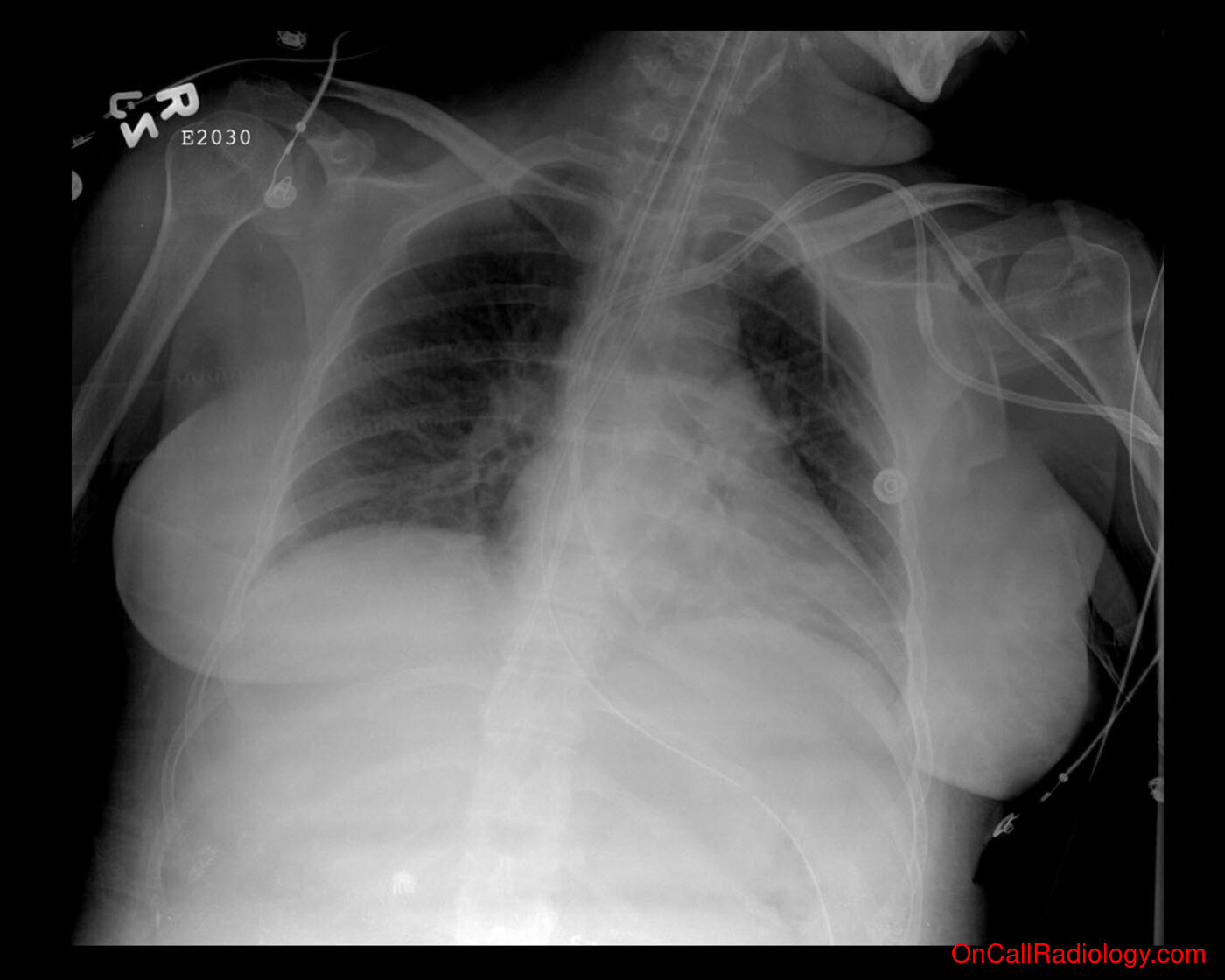 Tube and line misplacement (ET tube and central line misplacement - Plain film, Radiograph)
