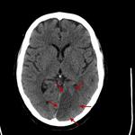 Left PCA infarct