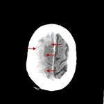 Subarachnoid hemorrhage, subdural bleed, brain edema, cerebral vasospasm