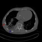 Serial rib fractures with hemopneumothorax, incidental lung adenocarcinoma