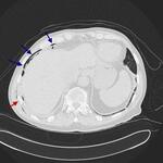 Serial rib fractures with hemopneumothorax, incidental lung adenocarcinoma