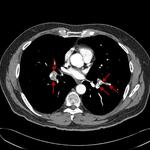 Shower of pulmonary emboli