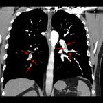 Shower of pulmonary emboli