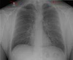 Pneumomediastinum
