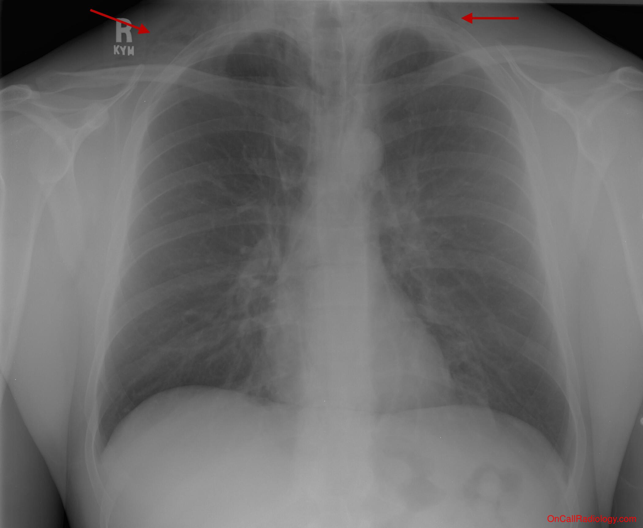 Air where it not belongs (Pneumomediastinum - CT, Radiograph)