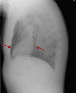 Pneumomediastinum
