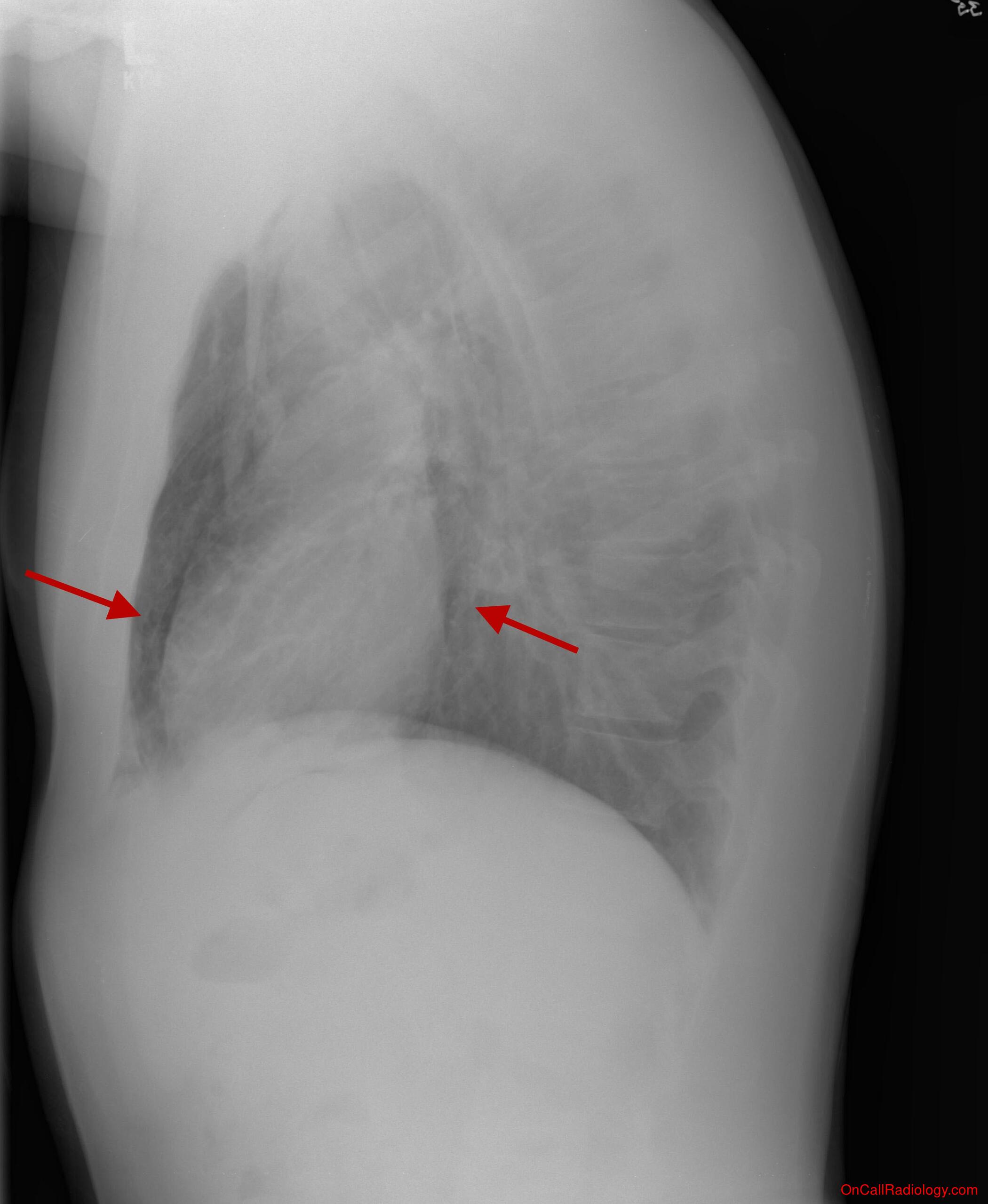 Air where it not belongs (Pneumomediastinum - CT, Radiograph)