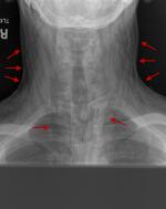 Pneumomediastinum