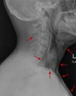 Pneumomediastinum