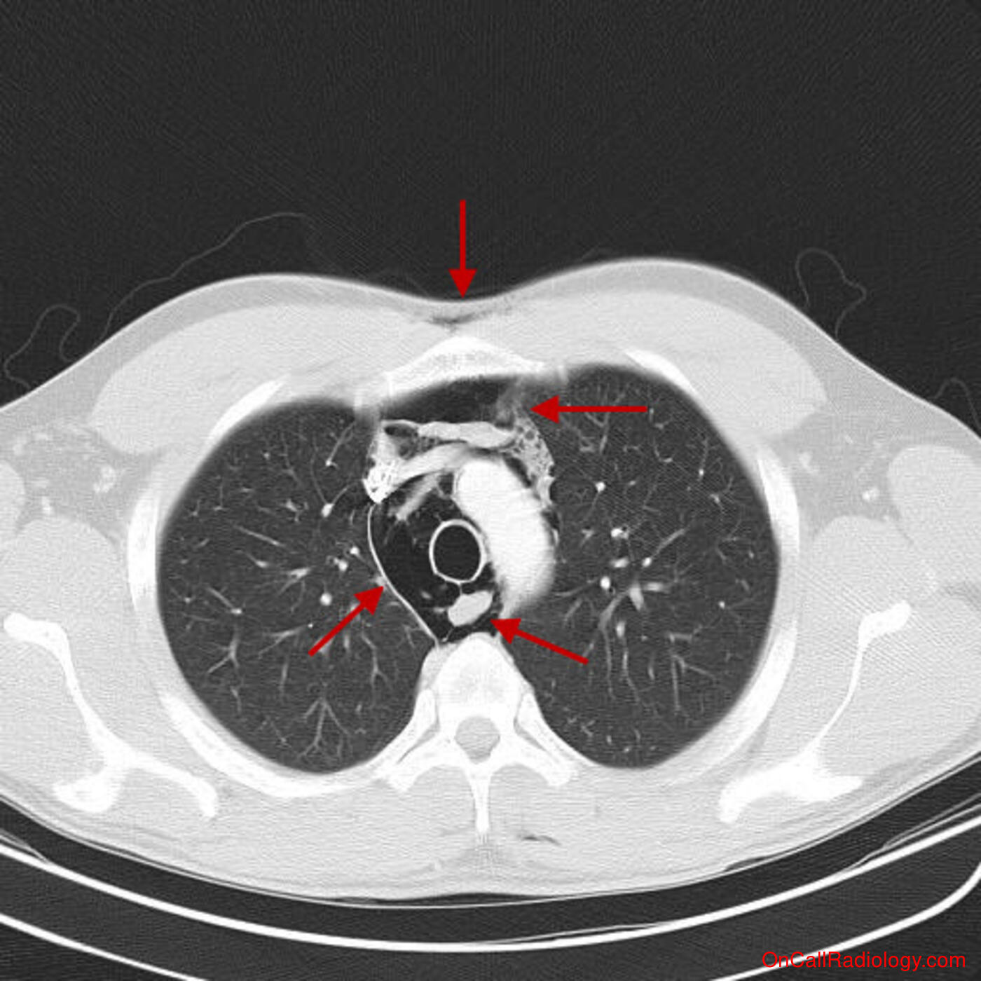 Air where it not belongs (Pneumomediastinum - CT, Radiograph)