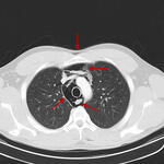 Pneumomediastinum