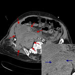 Large intra- and extraperitoneal hemorrhage