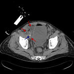 Large intra- and extraperitoneal hemorrhage