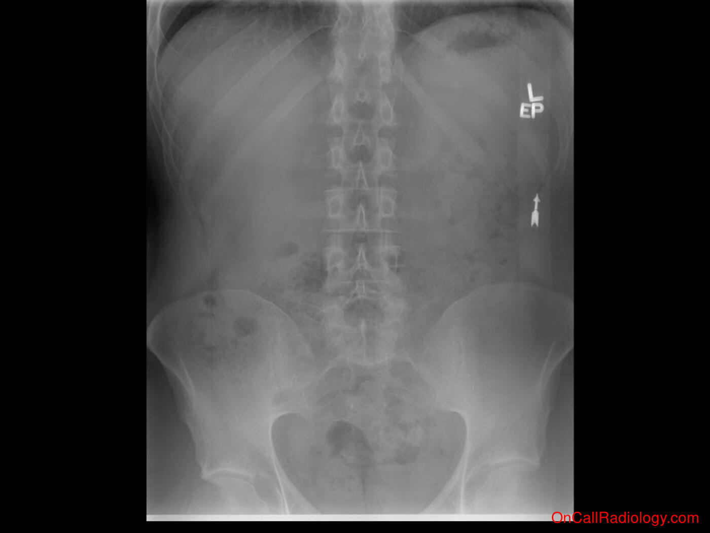 Bones (Spondylolysis with spondylolysthesis - Plain film, Radiograph)