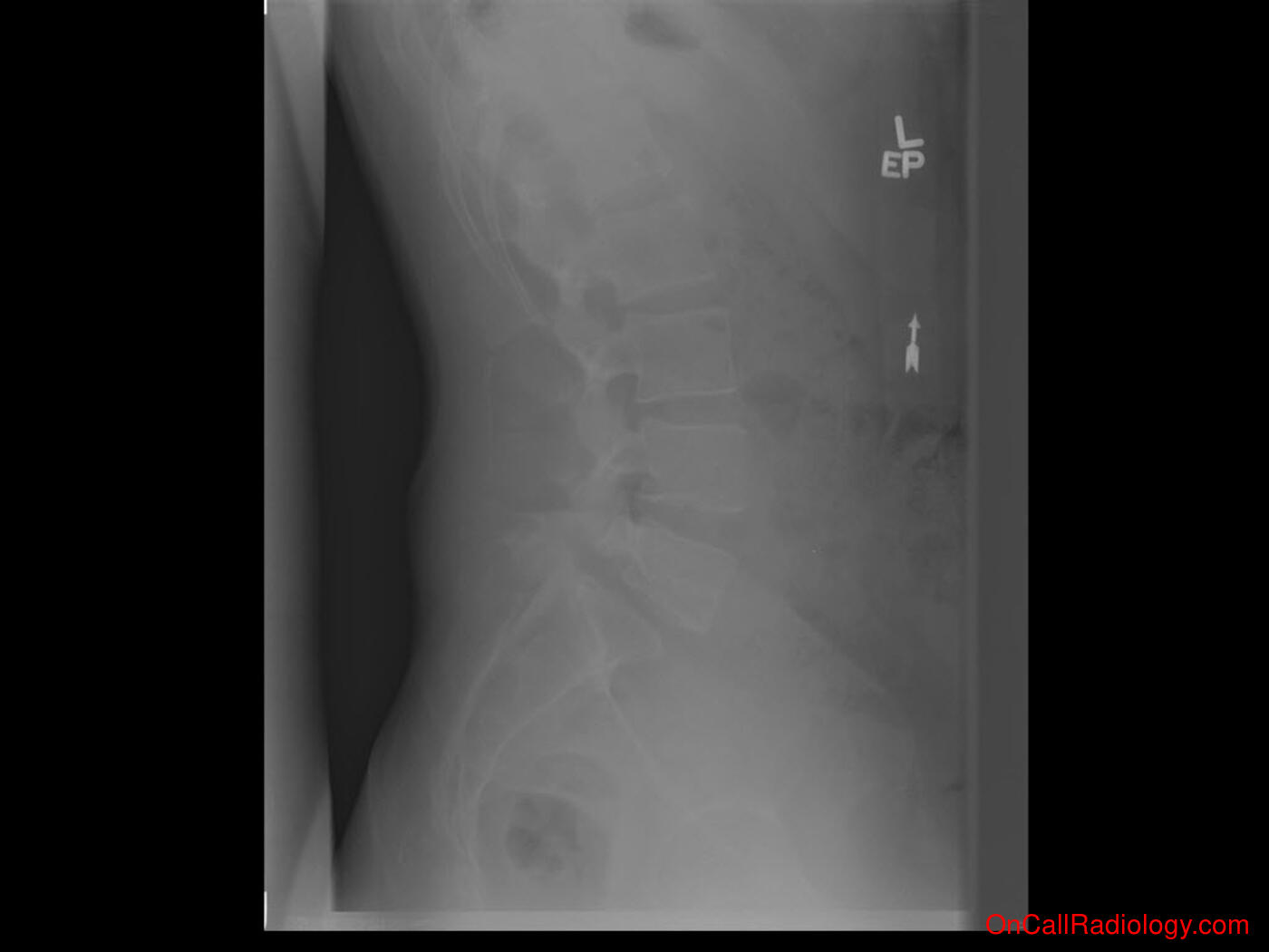 Bones (Spondylolysis with spondylolysthesis - Plain film, Radiograph)