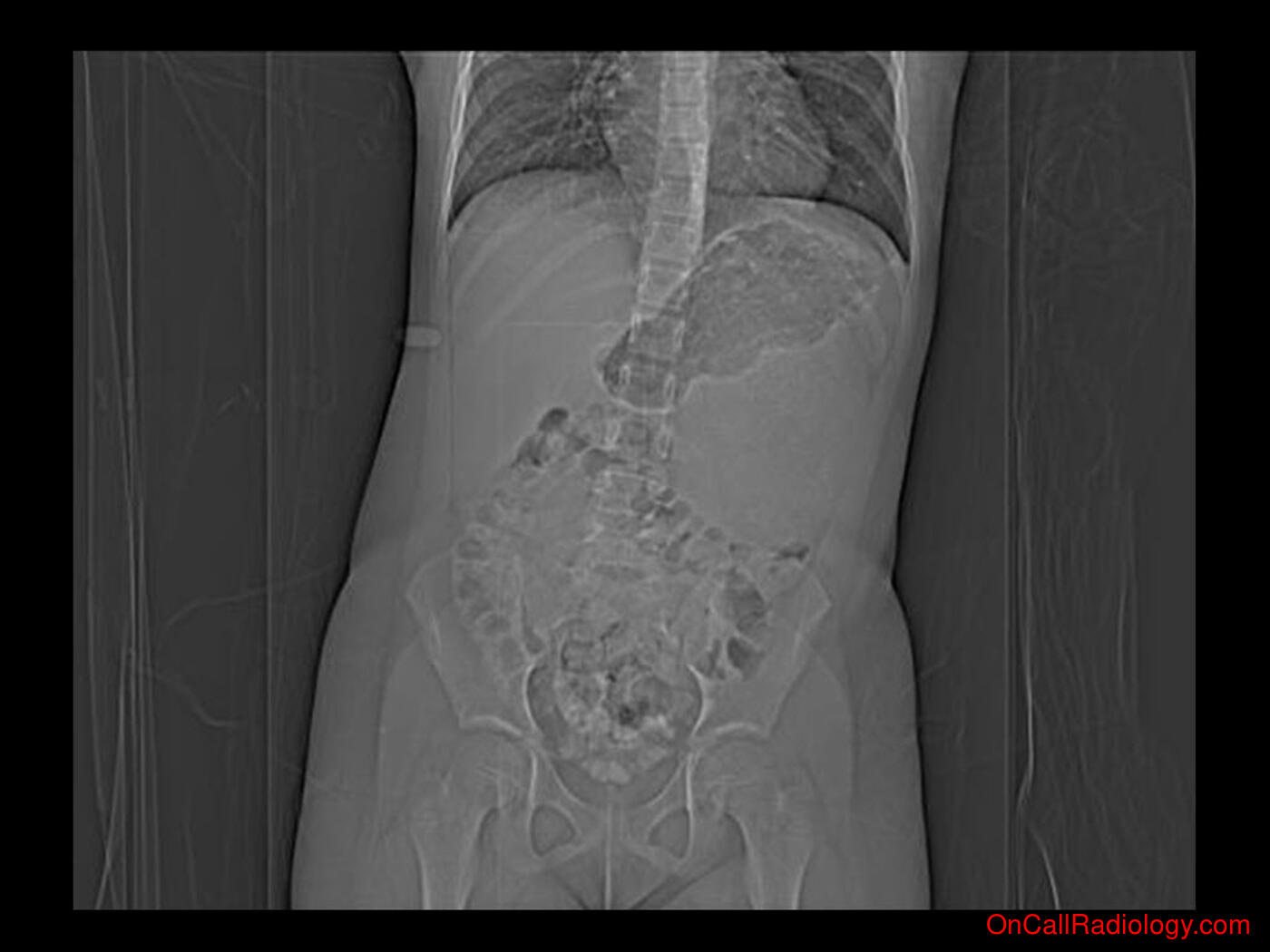 Mass effect (LUQ mass  - Plain film, Radiograph, CT, Computed tomography)