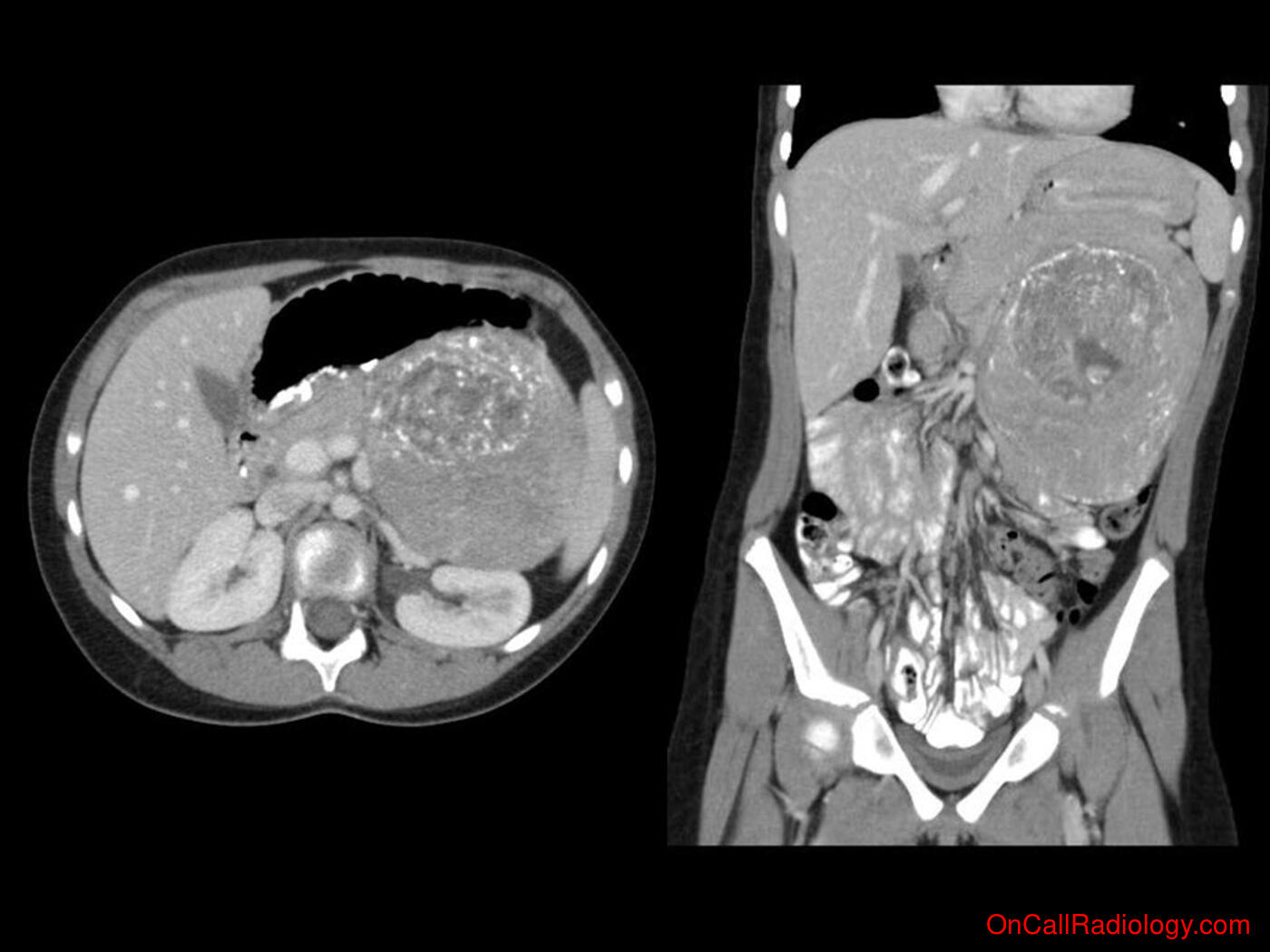 Mass effect (LUQ mass  - Plain film, Radiograph, CT, Computed tomography)