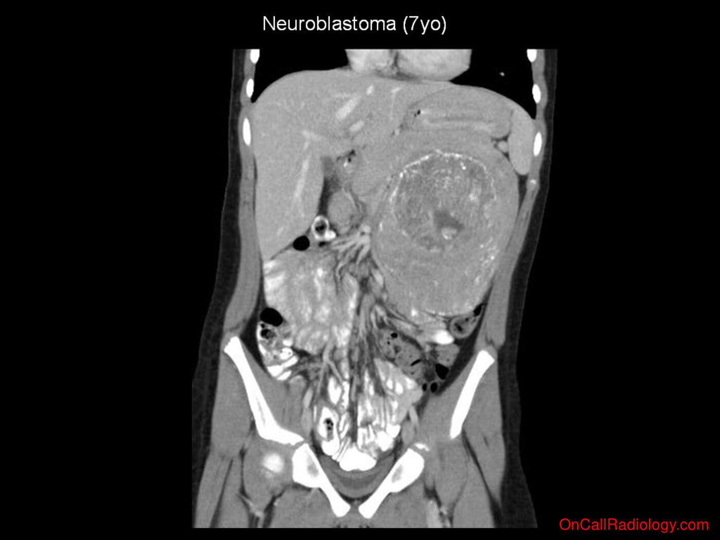 Mass effect (LUQ mass  - Plain film, Radiograph, CT, Computed tomography)