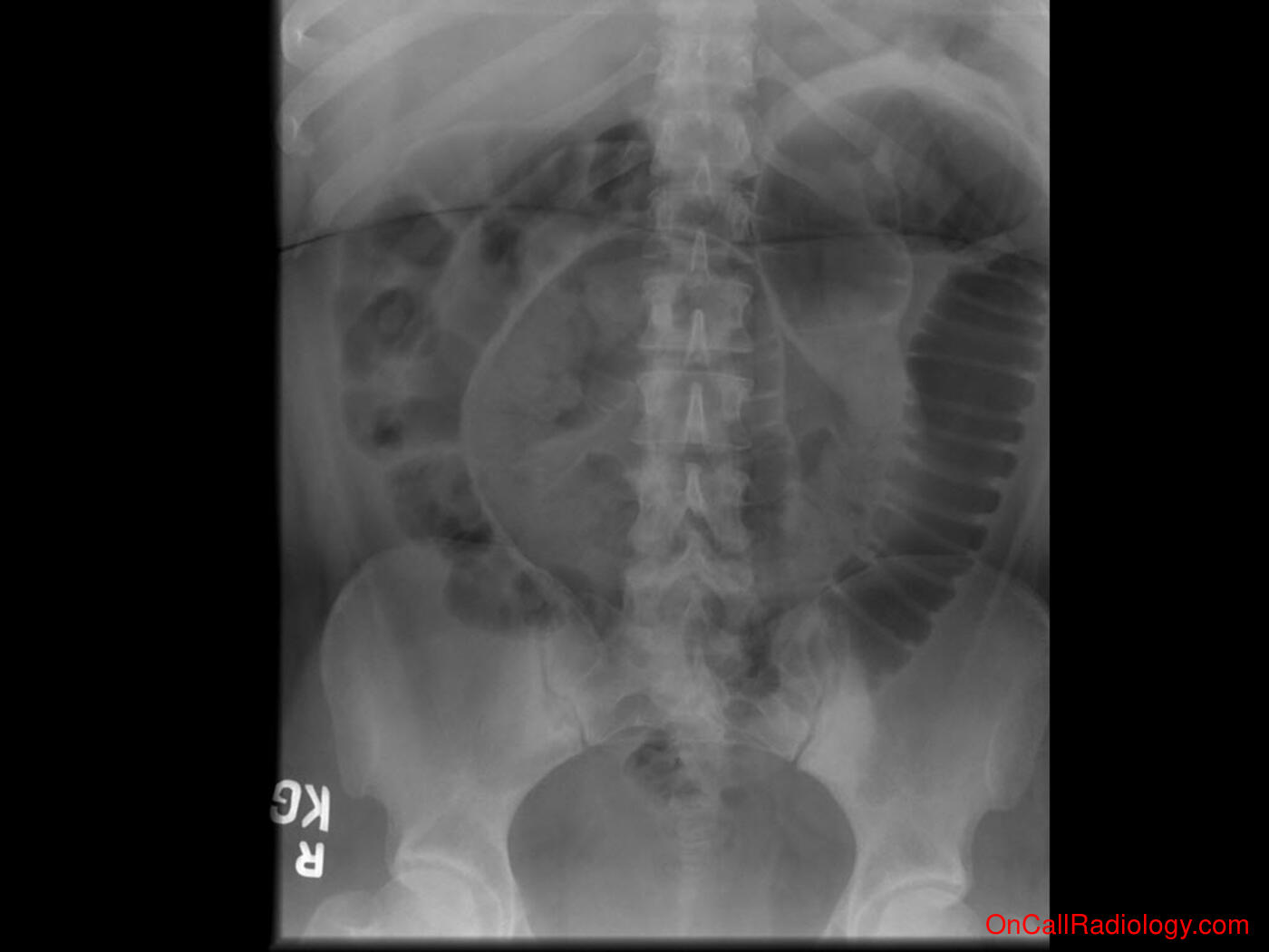 Air where it not belongs (Pneumoperitoneum with Rigler's sign - Plain film, Radiograph)