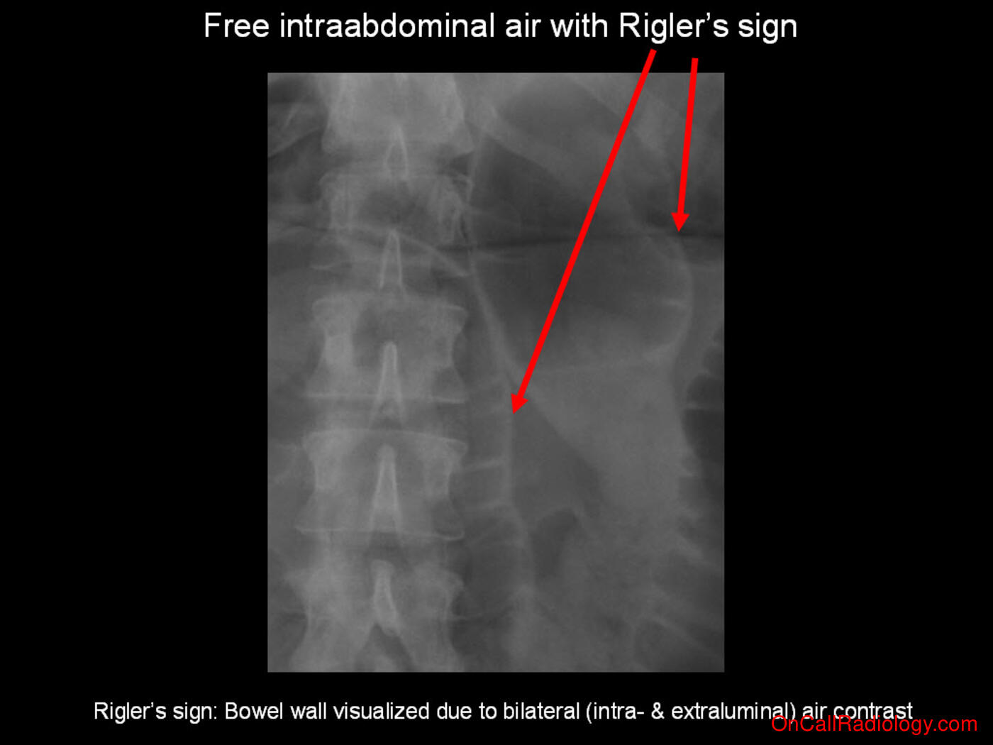 Air where it not belongs (Pneumoperitoneum with Rigler's sign - Plain film, Radiograph)