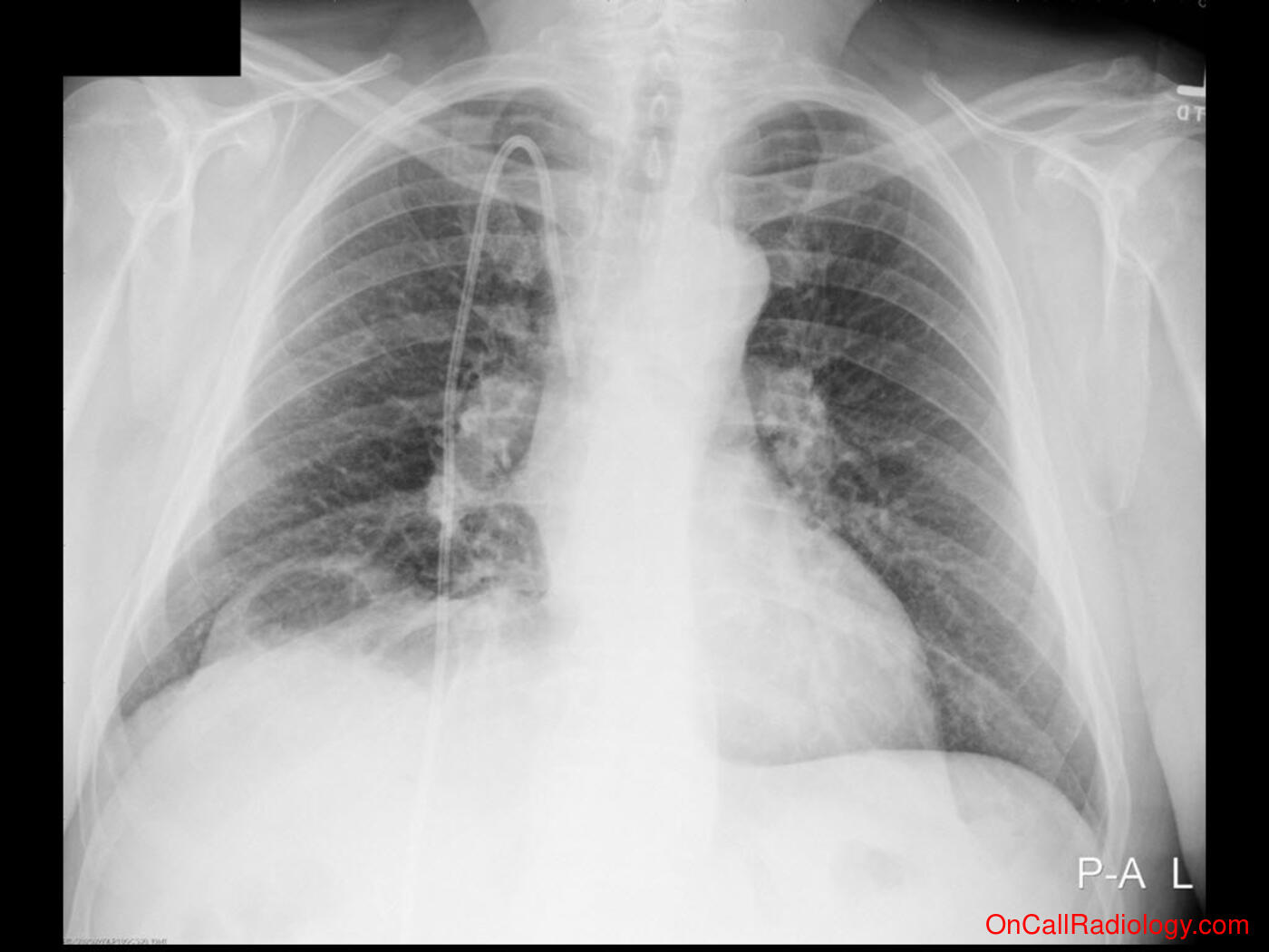 Air where it not belongs (Diaphragmatic eventration - Plain film, Radiograph)