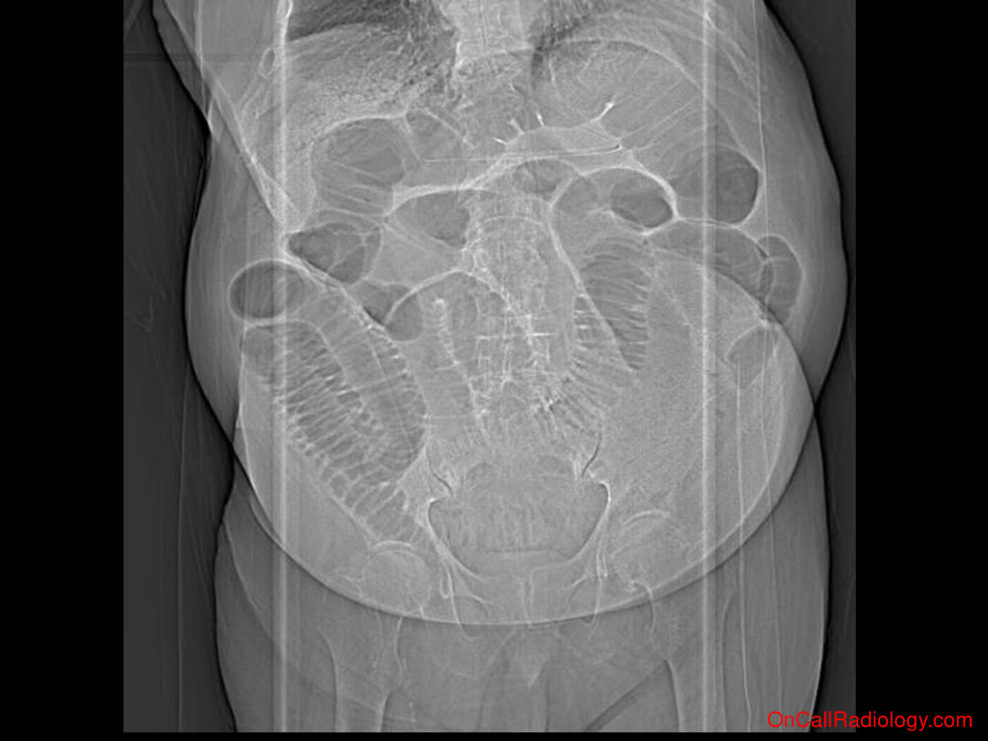 Obstruction (Pneumatosis and portal venous gas - Plain film, Radiograph, CT, Computed tomography)
