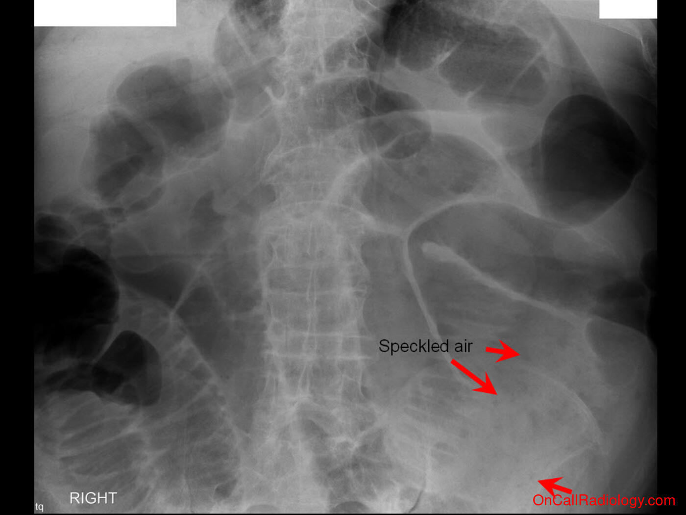 Obstruction (Pneumatosis and portal venous gas - Plain film, Radiograph, CT, Computed tomography)
