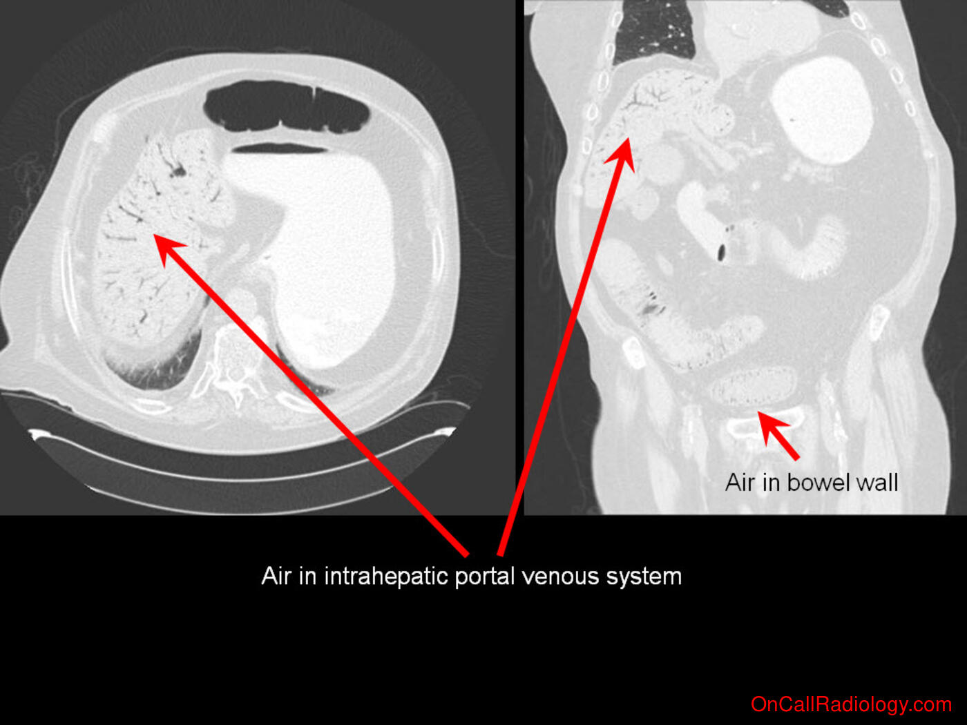Obstruction (Pneumatosis and portal venous gas - Plain film, Radiograph, CT, Computed tomography)