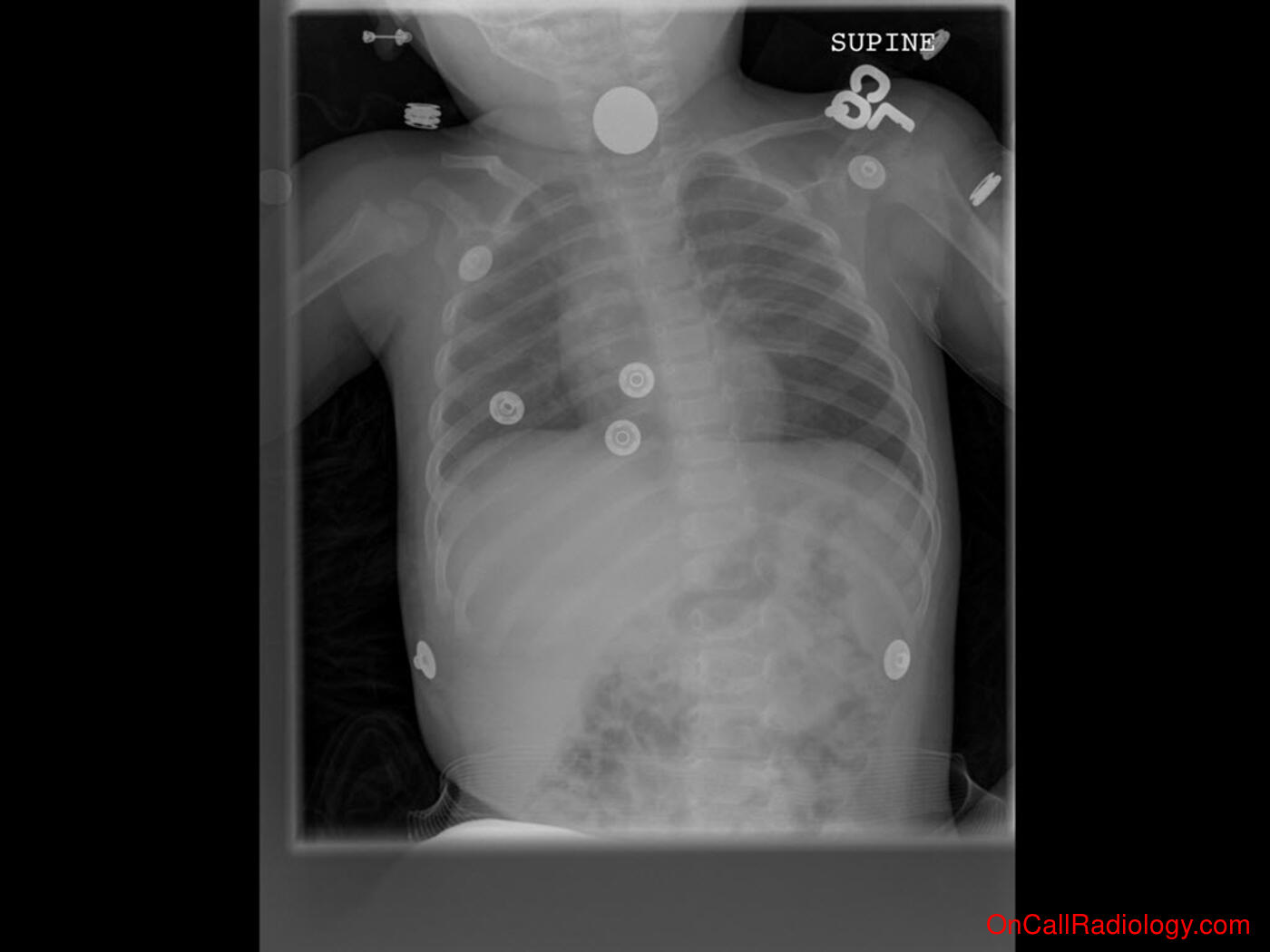 Foreign body (Coin in esophagus - Plain film, Radiograph)