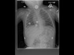 Coin in esophagus