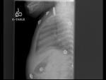 Coin in esophagus