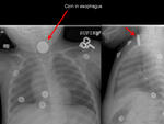 Coin in esophagus