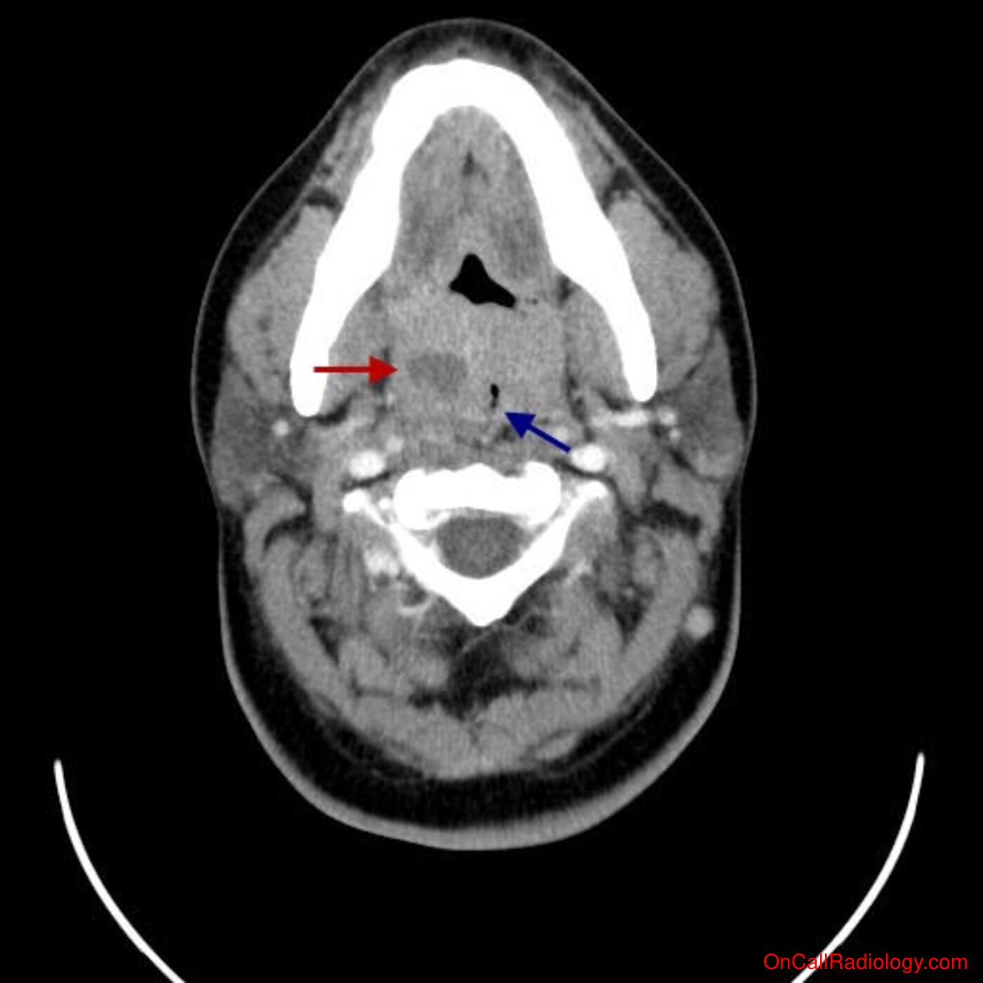 Neck (Tonsillar abscess - CT)