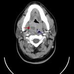 Tonsillar abscess