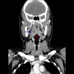 Tonsillar abscess