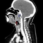 Tonsillar abscess