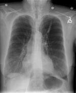 COPD