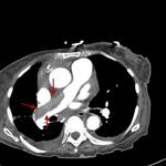 Incidental pulmonary embolus on abdominal CT, right atrial thrombus