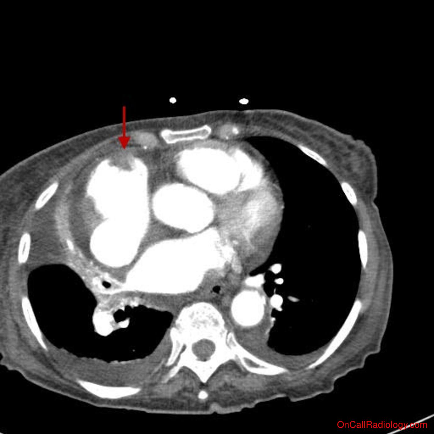Thromboembolic disease (Incidental pulmonary embolus on abdominal CT, right atrial thrombus - CT)