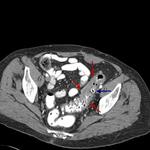 Acute diverticulitis